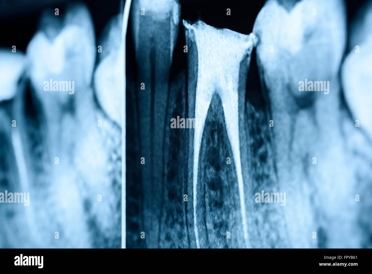 Scleroterapia completo del canale radicolare sistemi sui denti X-Ray Foto Stock