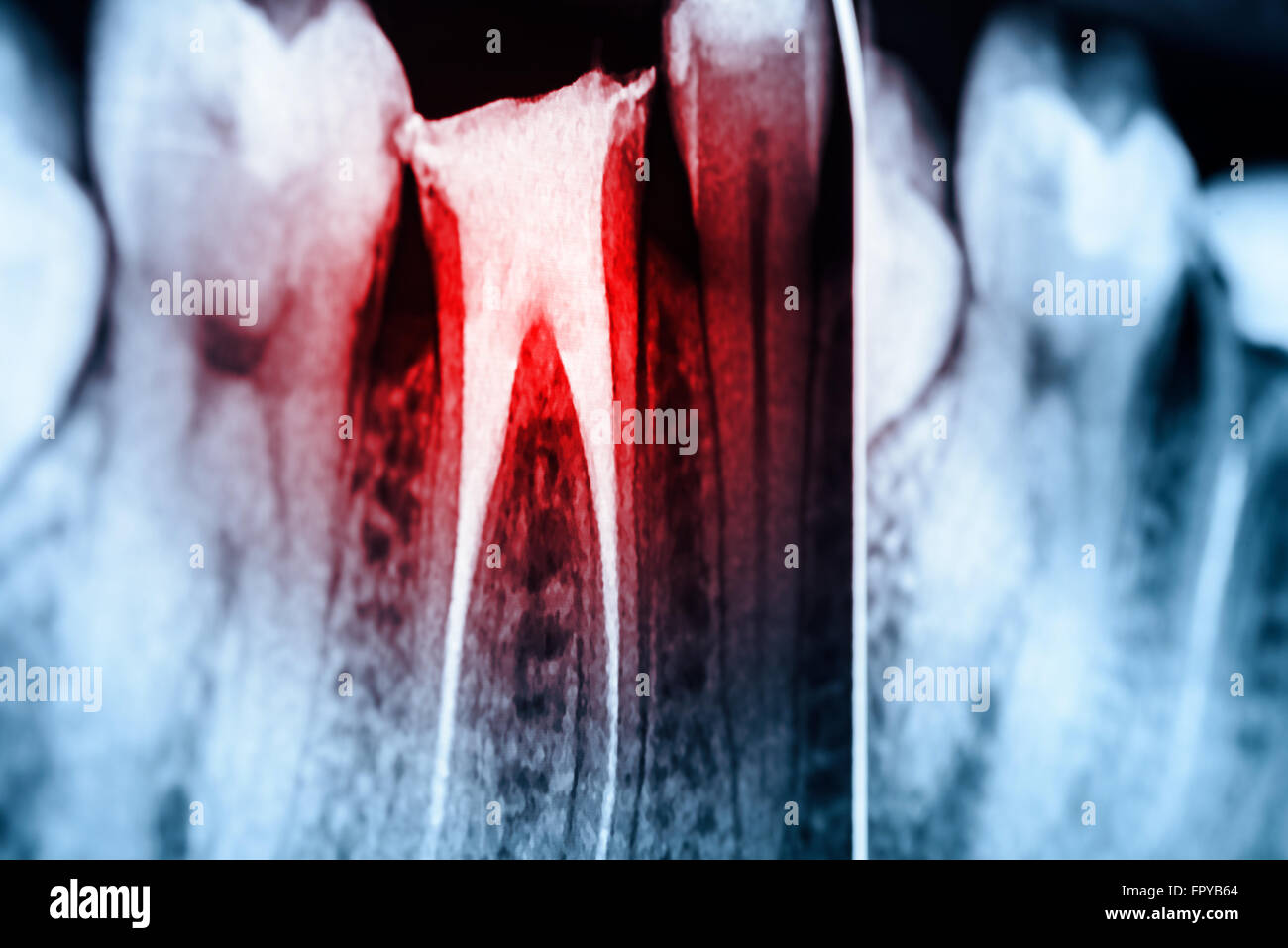 Scleroterapia completo del canale radicolare sistemi sui denti X-Ray Foto Stock