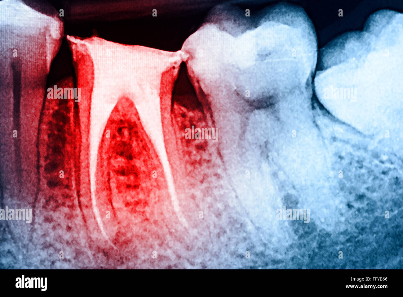 Scleroterapia completo del canale radicolare sistemi sui denti X-Ray Foto Stock