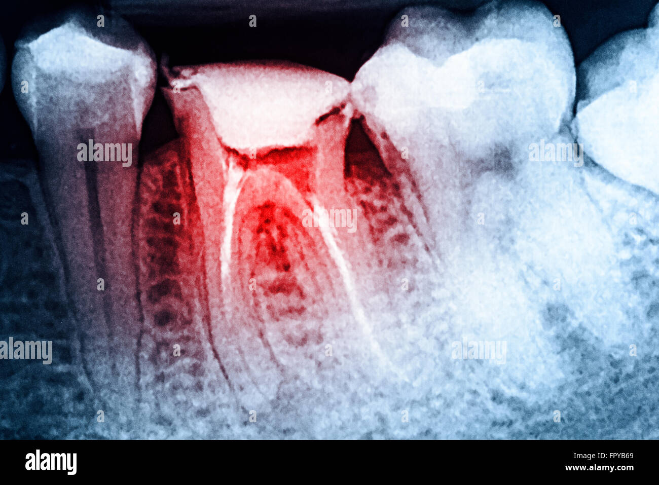 Scleroterapia completo del canale radicolare sistemi sui denti X-Ray Foto Stock