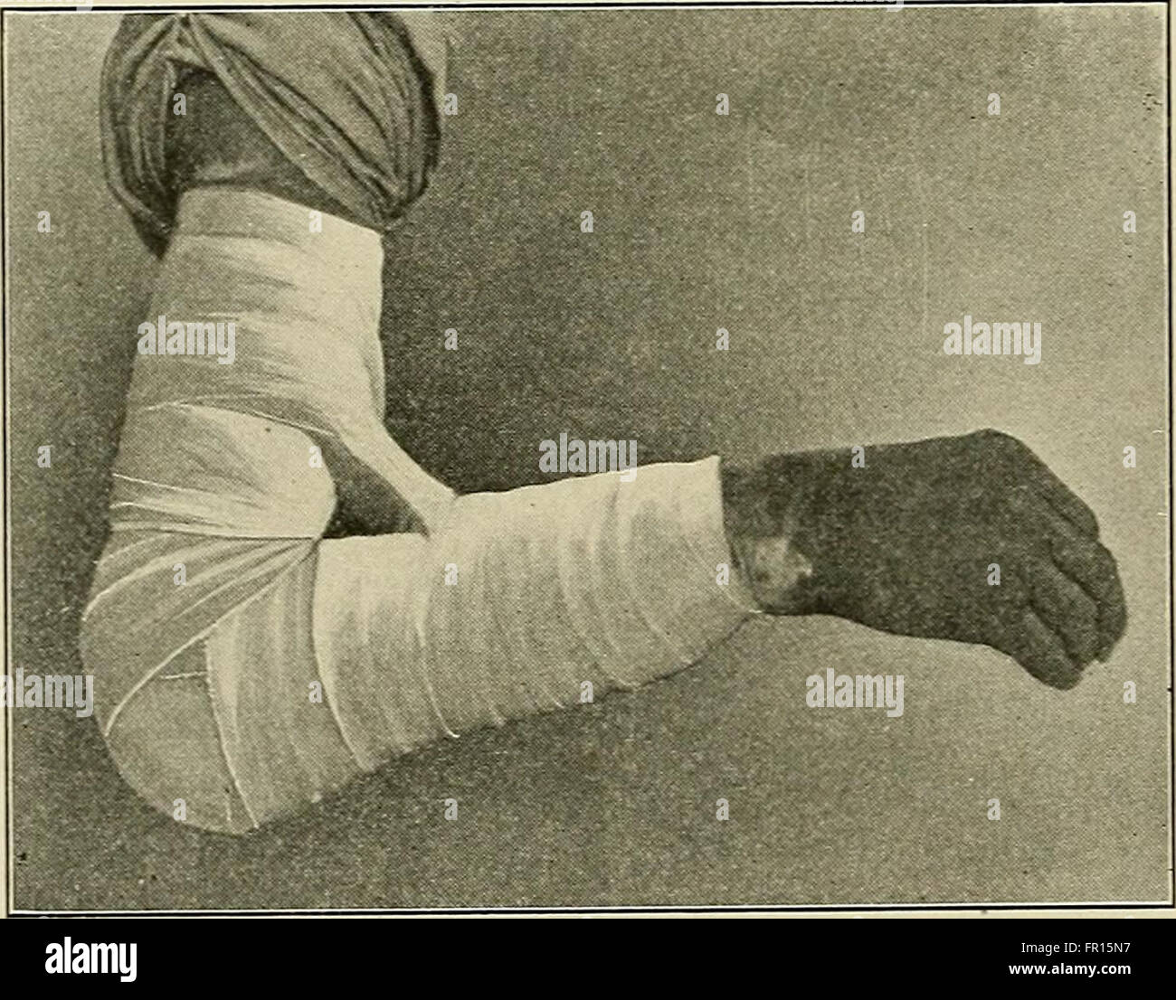 Questo manuale del 1913 illustra i processi di trattamento pre- e post-operatorio, offrendo una panoramica storica delle prime pratiche mediche, delle procedure chirurgiche e della cura del paziente. Foto Stock