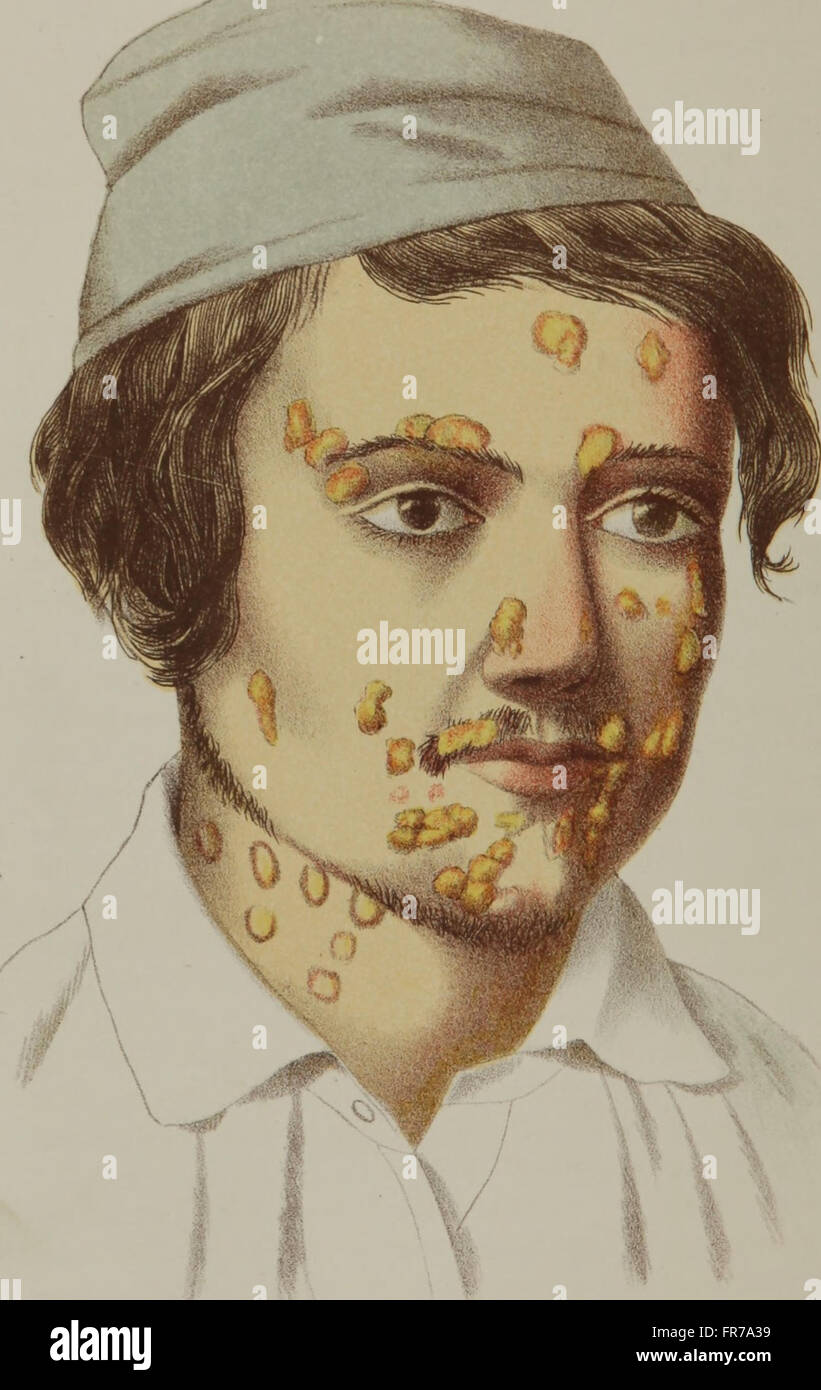 Un trattato di gonorrea e sifilide (1864) Foto Stock