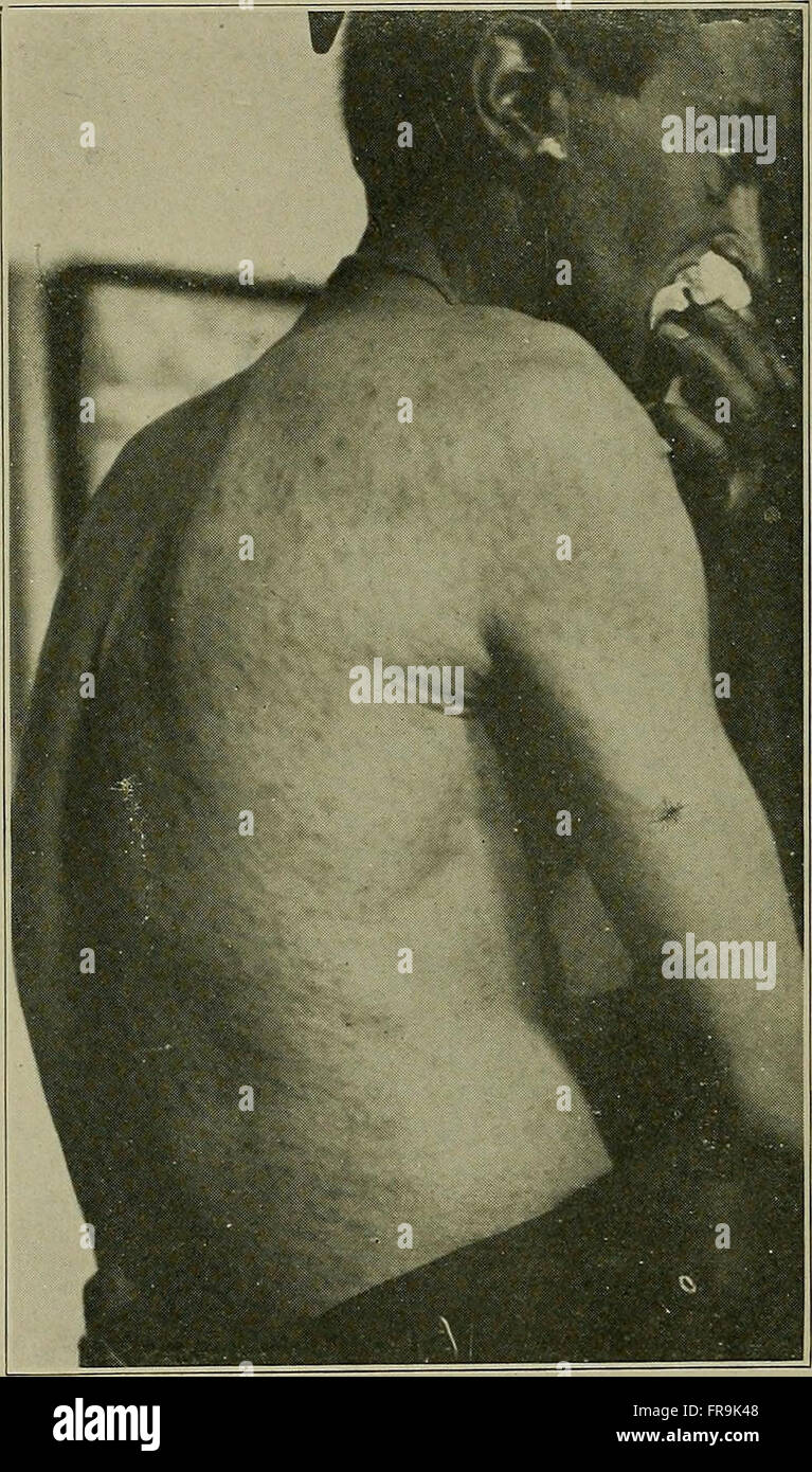 La sifilide - un trattato di eziologia, patologia, diagnosi, prognosi per la profilassi e il trattamento (1921) Foto Stock