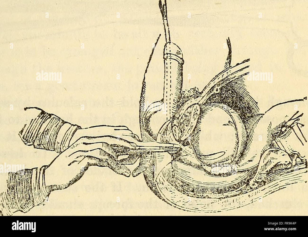 Lezioni sull'eclettico sistema di chirurgia (1866) Foto Stock