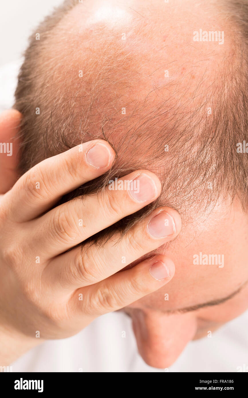 Calvizie Alopecia uomo perdita di capelli Foto Stock