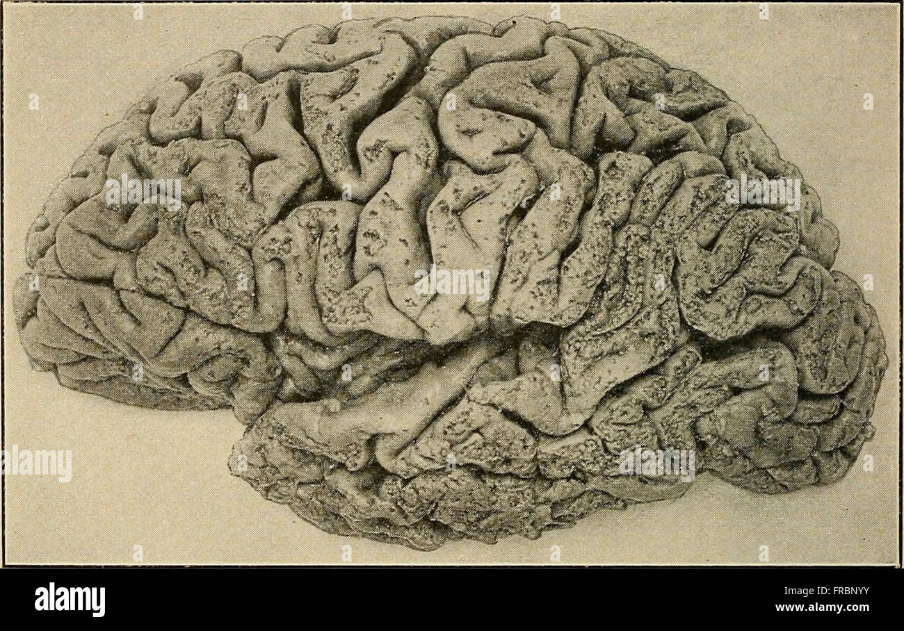 Un libro di testo del 1915 sulle malattie del sistema nervoso, tra cui neurologia e psichiatria. Il libro discute la diagnosi, il trattamento e la comprensione dei disturbi neurologici e psicologici del tempo. Foto Stock