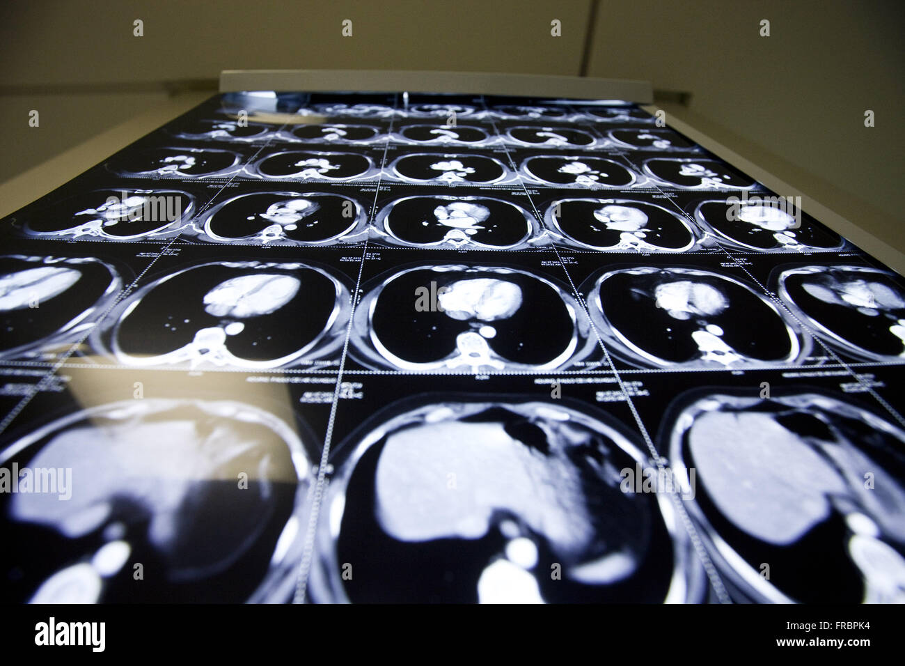 Risultati della tomografia computerizzata in ICU lightbox Foto Stock