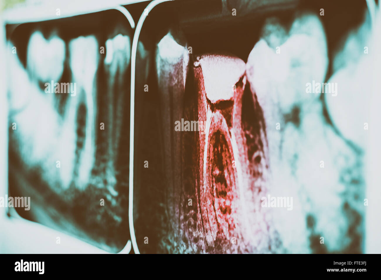 Dolore retrò di carie sui denti X-Ray Foto Stock