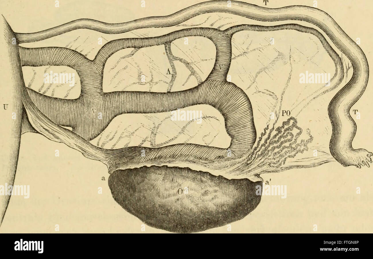 Questo lavoro del 1878 sull'anatomia patologica dell'infertilità femminile discute i meccanismi e i metodi di trattamento per l'infertilità, concentrandosi sugli aspetti medici e sulla salute riproduttiva. Foto Stock