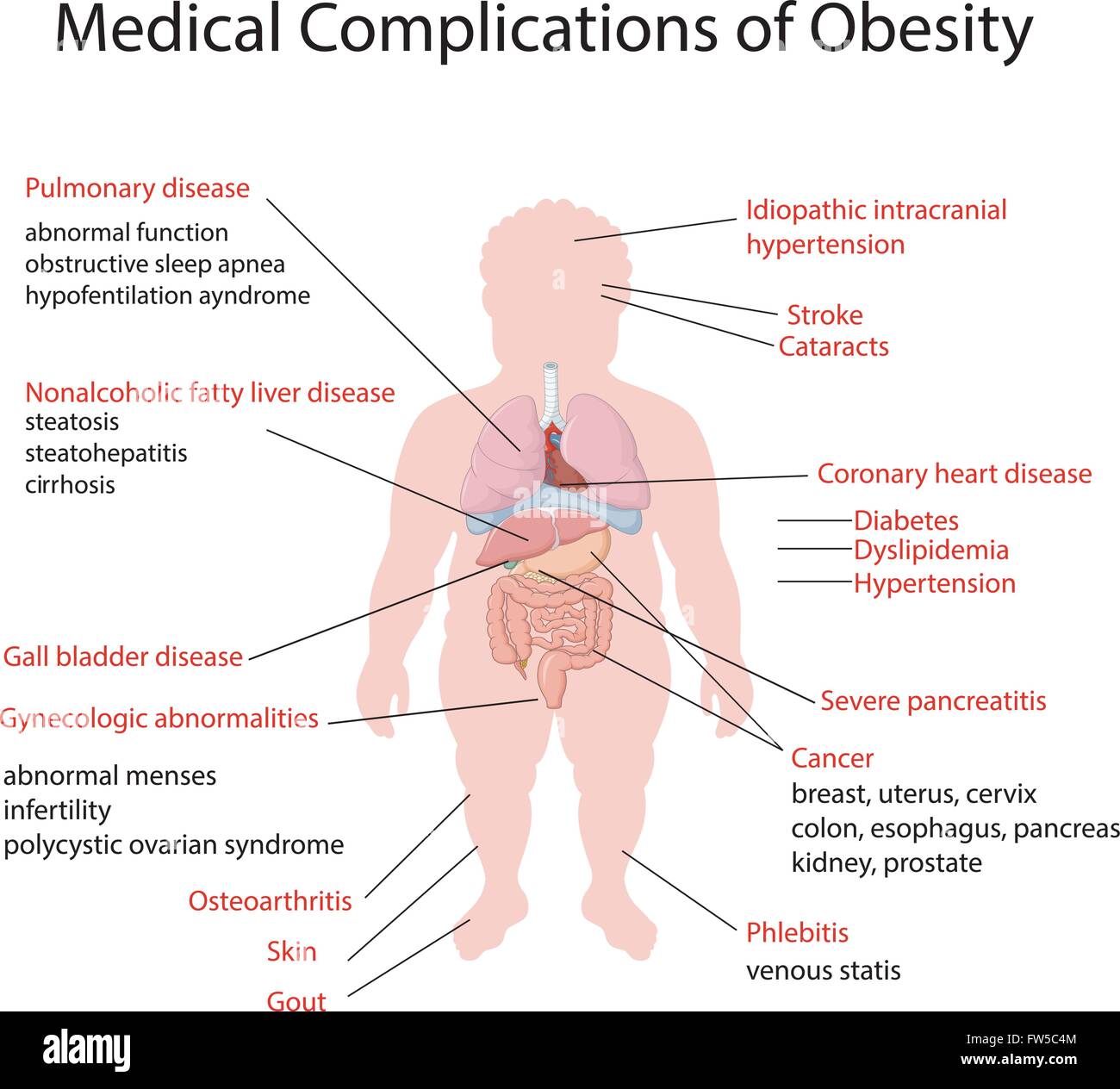 Illustrazione della complicazione medica dell'obesità Illustrazione Vettoriale