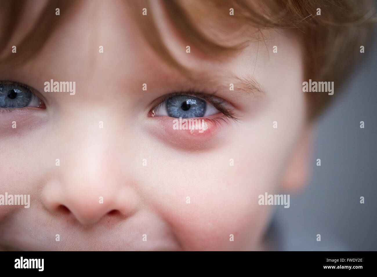 Un stye esterno o sty anche orzaiolo, è una infezione delle ghiandole sebacee di Zeis alla base delle ciglia o un infe Foto Stock