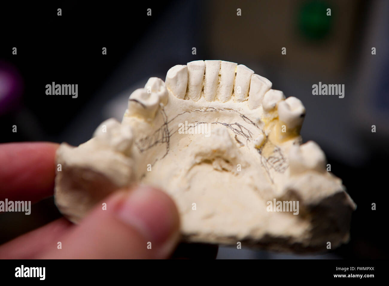 Artificiale di riparazione dei denti umani Foto Stock