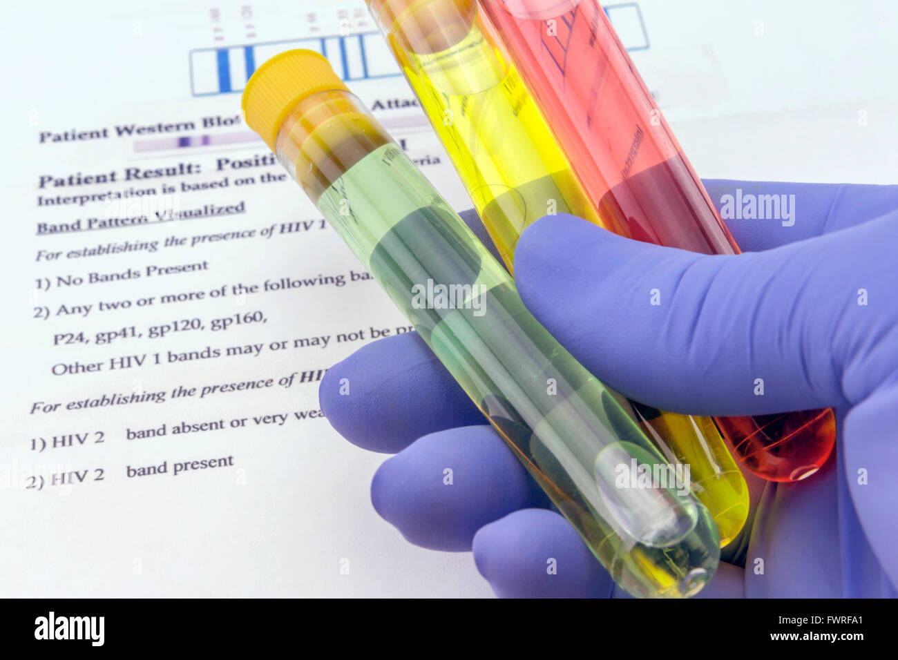 Campione di sangue e la richiesta di laboratorio per anti-HIV Test Foto Stock