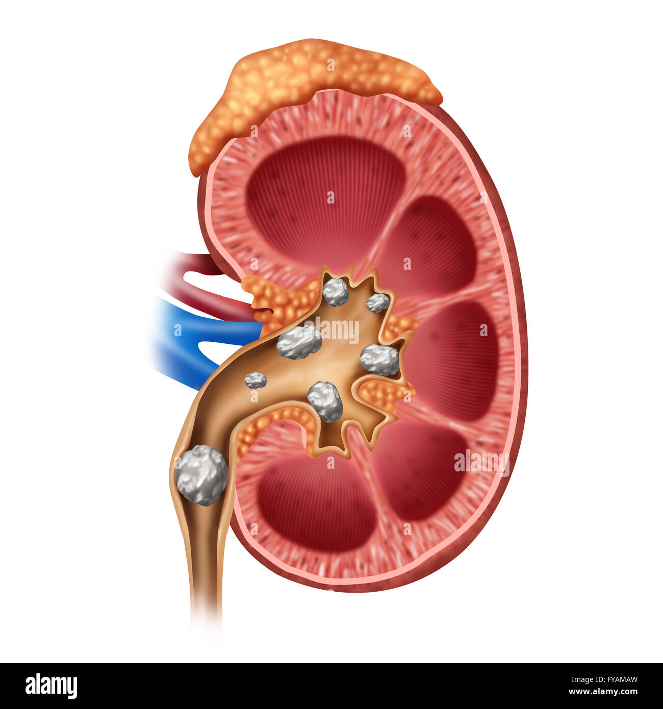 Calcoli renali concetto medico come un organo umano con dolorose di cristallinità formazioni minerali come un simbolo di medici con una sezione trasversale come 3D illustrazione dello stile. Foto Stock