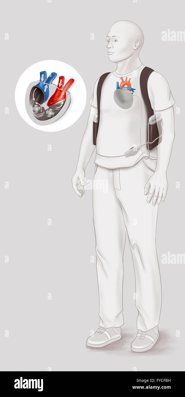 Cuore Artificiale, disegno Foto Stock