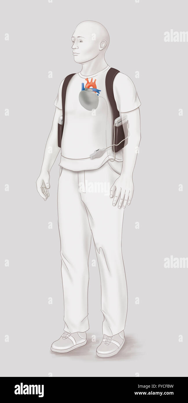 Cuore Artificiale, disegno Foto Stock