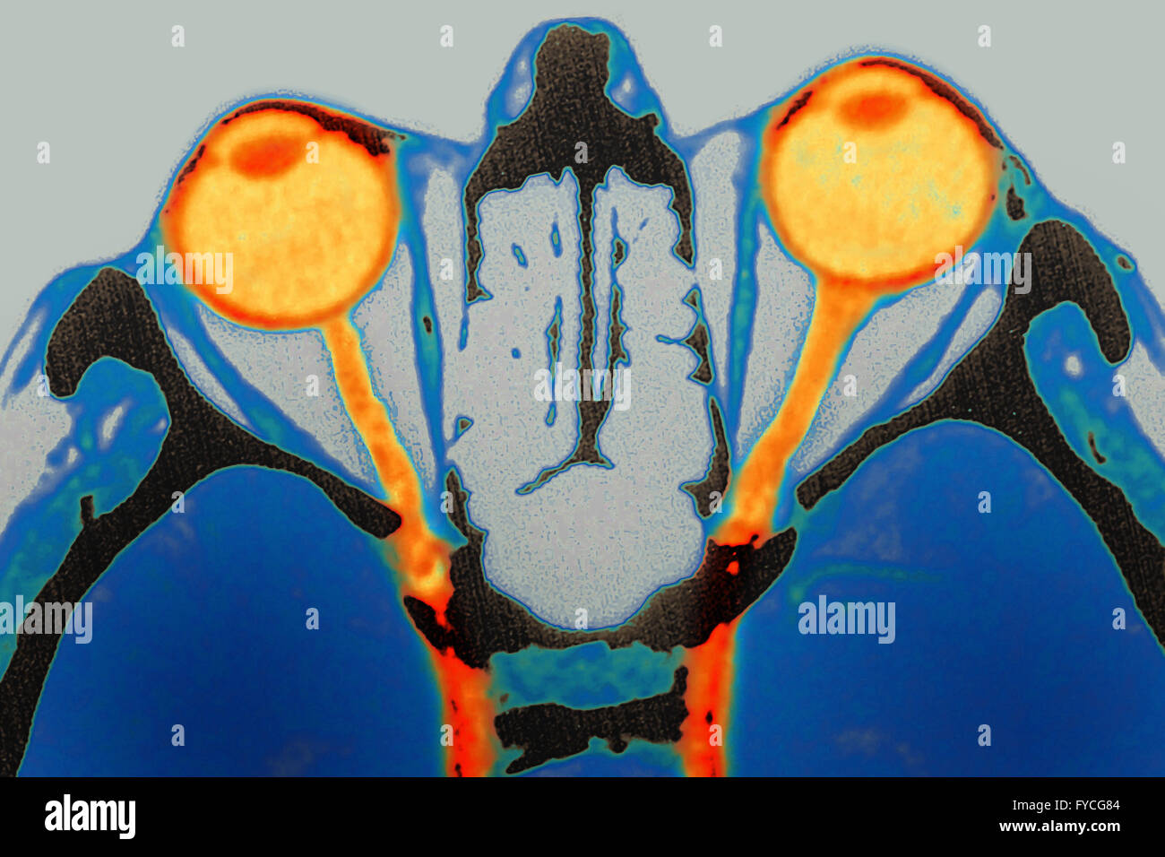 Nervo ottico, scansione Foto Stock