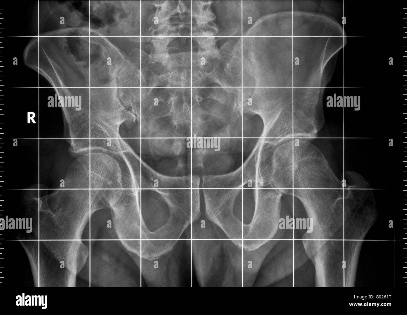 X-ray di obliquità pelvica Foto Stock