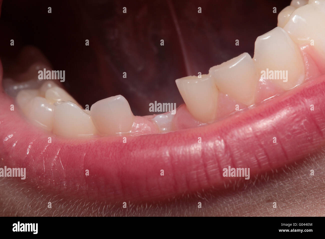 spacco del dente Foto Stock