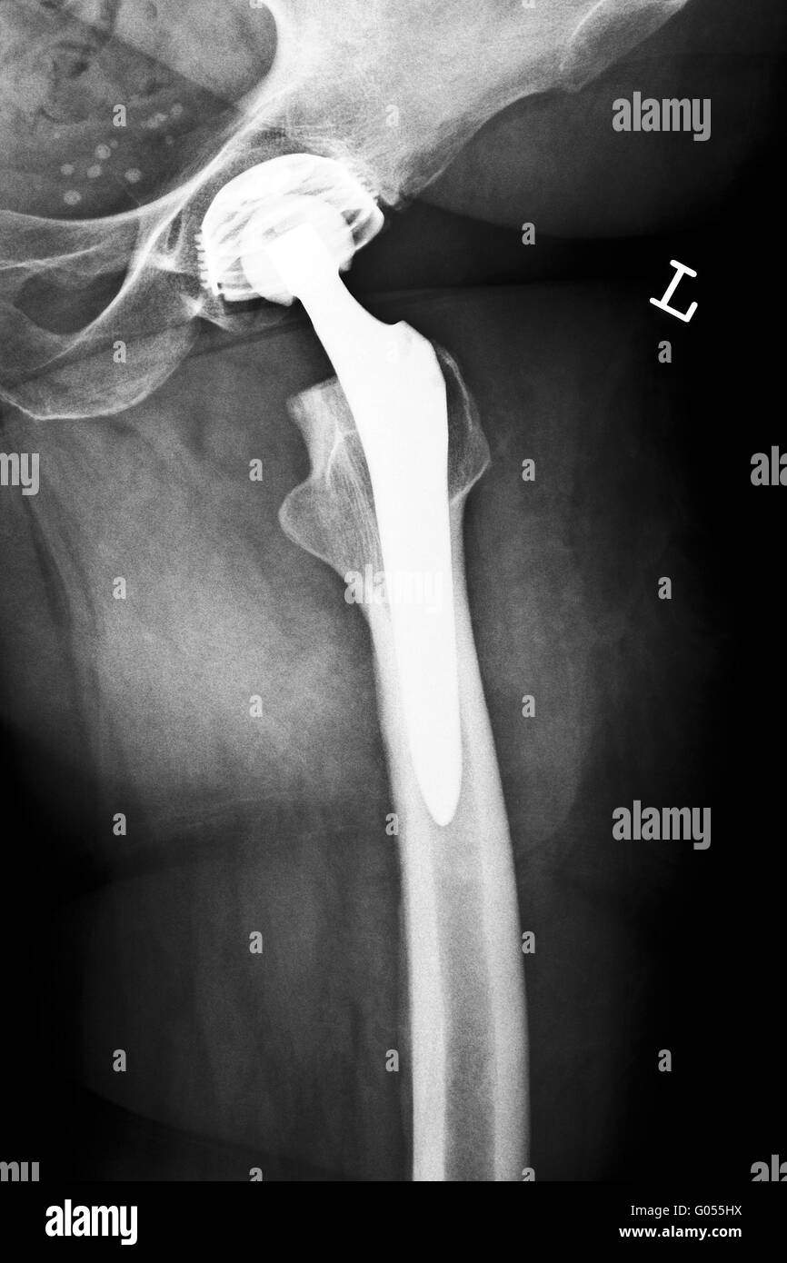 Articolazione artificiale dell'anca Foto Stock
