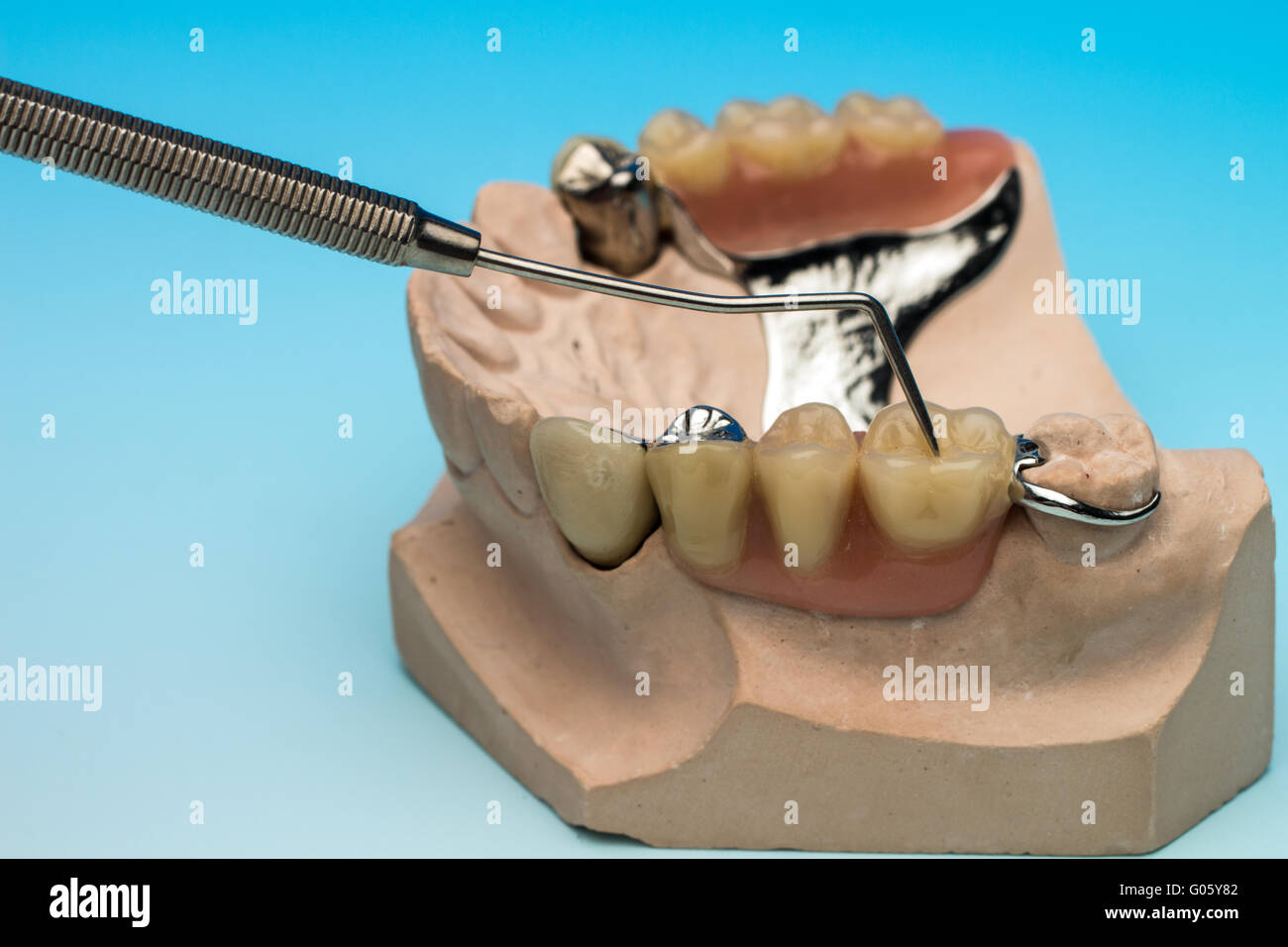 Modellgußprotese con ponte in metallo Foto Stock