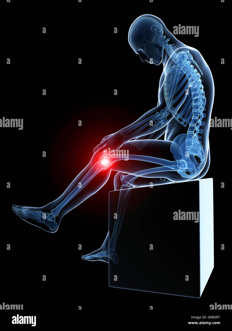 Rendering 3d Illustrazione medica - dolorosa ginocchio Foto Stock