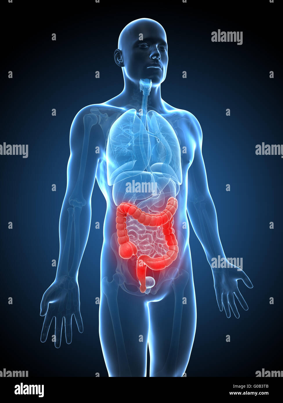 3d reso illustrazione di un'infiammazione del colon Foto Stock