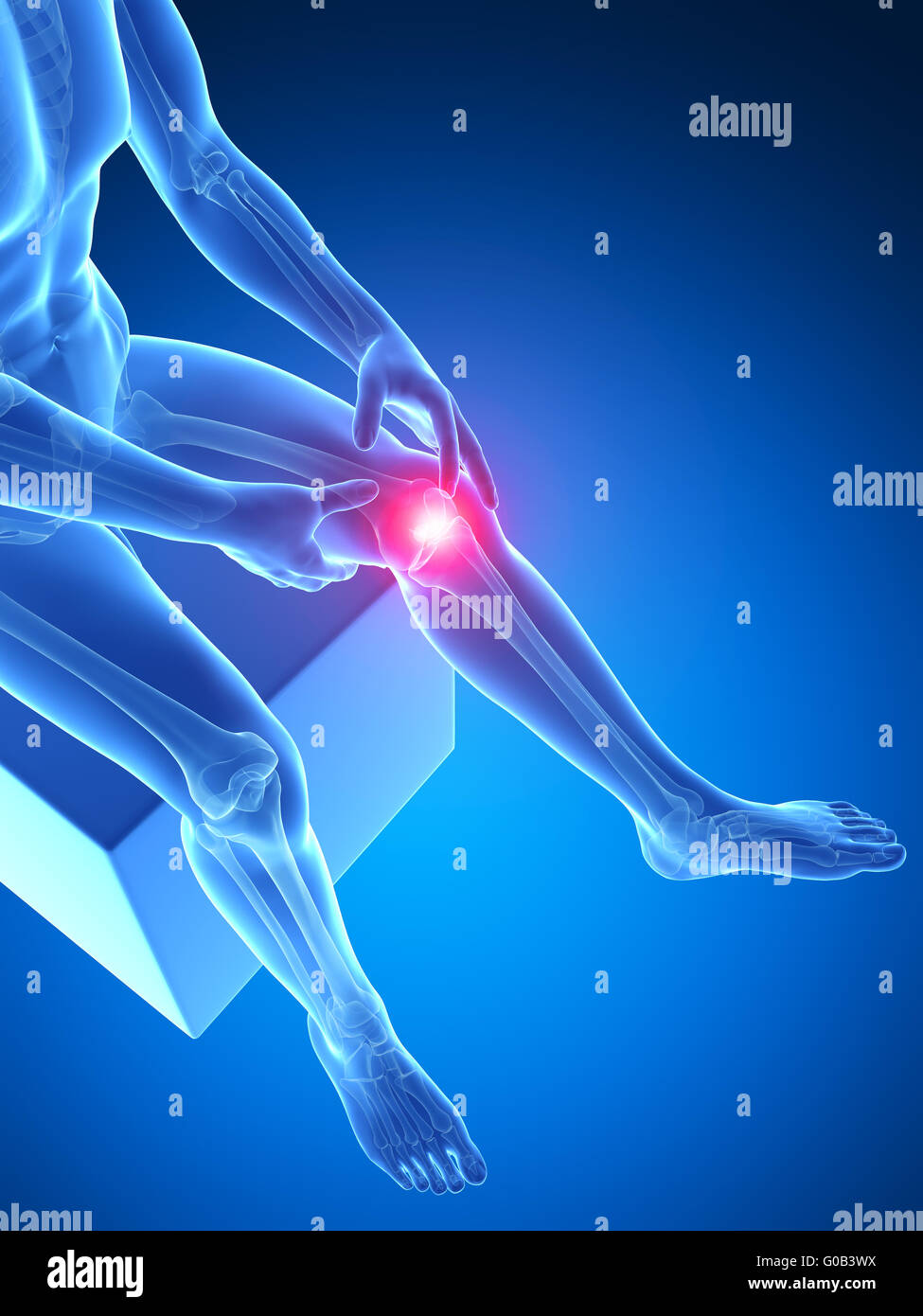 Rendering 3d Illustrazione medica - dolorosa ginocchio Foto Stock