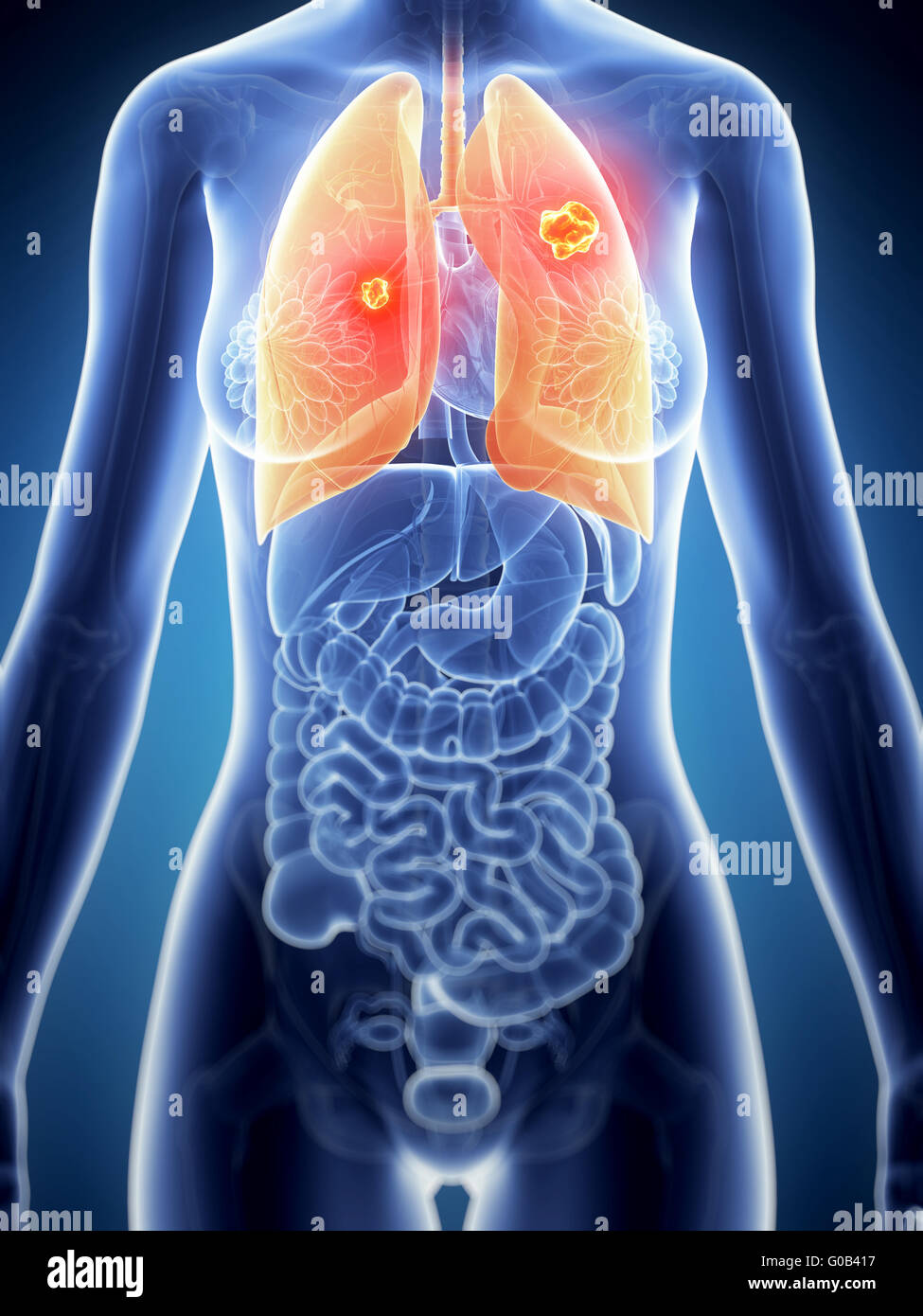 3d reso illustrazione dell'anatomia femminile - il cancro ai polmoni Foto Stock