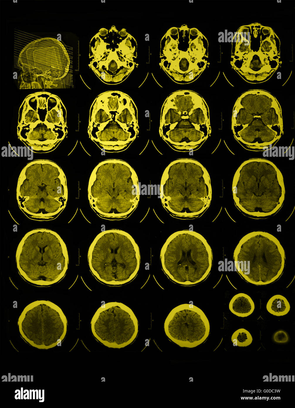 Foto di CT e MRI del cranio Foto Stock