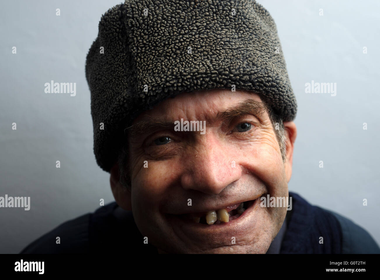 Uomo con difficoltà di apprendimento vivere con inutilizzabile il cancro alla gola Foto Stock