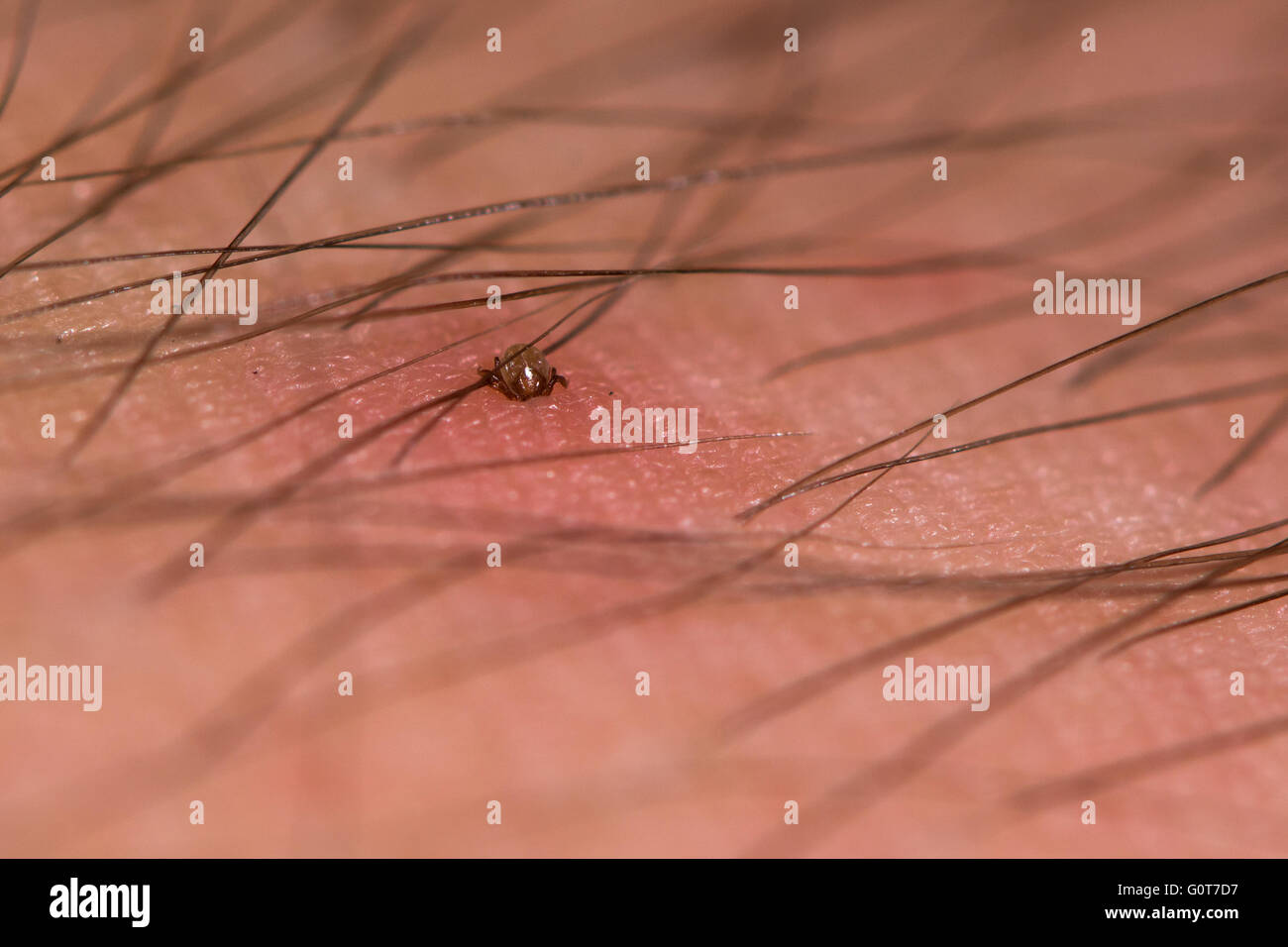 Tick mordere uomo peloso del braccio. Una piccola ninfa Pecore tick (Ixodes ricinus) alimentazione di sangue attraverso la pelle della persona. Foto Stock