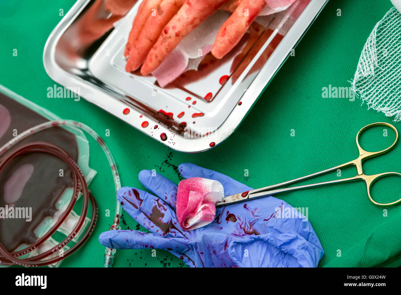 Unità di concentrato di globuli rossi, emostatiche Kocher forcipe, trapianto di arto superiore in una sala operatoria Foto Stock