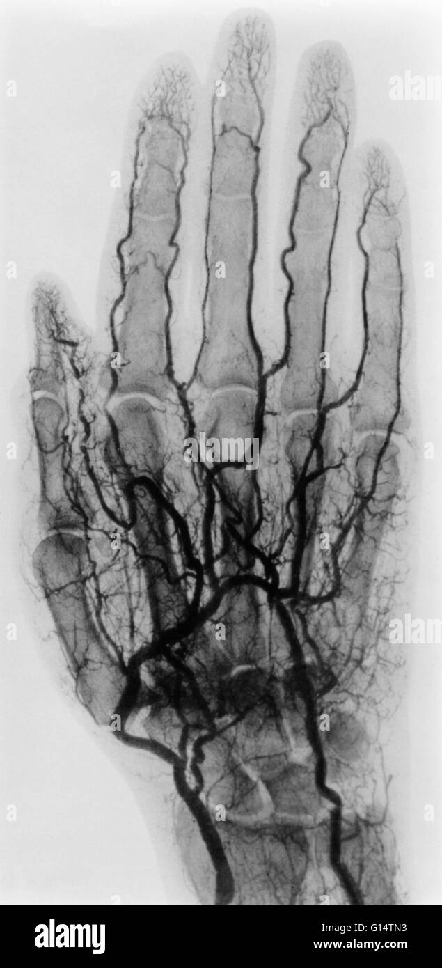 Arteriogram di una mano. L'arteria radiale può essere visto nella parte inferiore sinistra e l'Arteria ulnare in basso a destra. Questo inizio di raggi x è stata fatta da Alfred G. Fryatt e pubblicato in "archivi della Roentengen' (1904). L'immagine è di mano di un cadavere la maggior parte Foto Stock