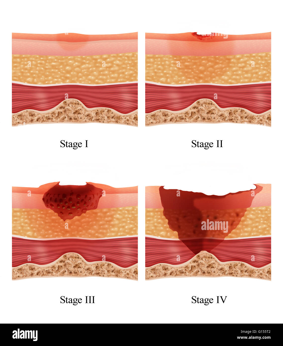 Illustrazione che mostra le fasi di un letto mal o ulcera di pressione. Piaghe da letto può essere causata da molti fattori tra cui la pressione non alleviata, attrito, umidità, ecc. Letto di solito le piaghe che affliggono la fragile e anziani, legato in sedia a rotelle e persone terminalmente Foto Stock