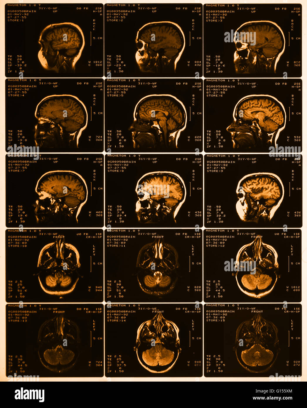 Colore esaltato foglio di MRI mostra che mostra la normale anatomia del cervello. Notevoli sono la corteccia cerebrale, corpo calloso, talamo, micollo allungato, nel cervelletto e nel tronco cerebrale. Foto Stock
