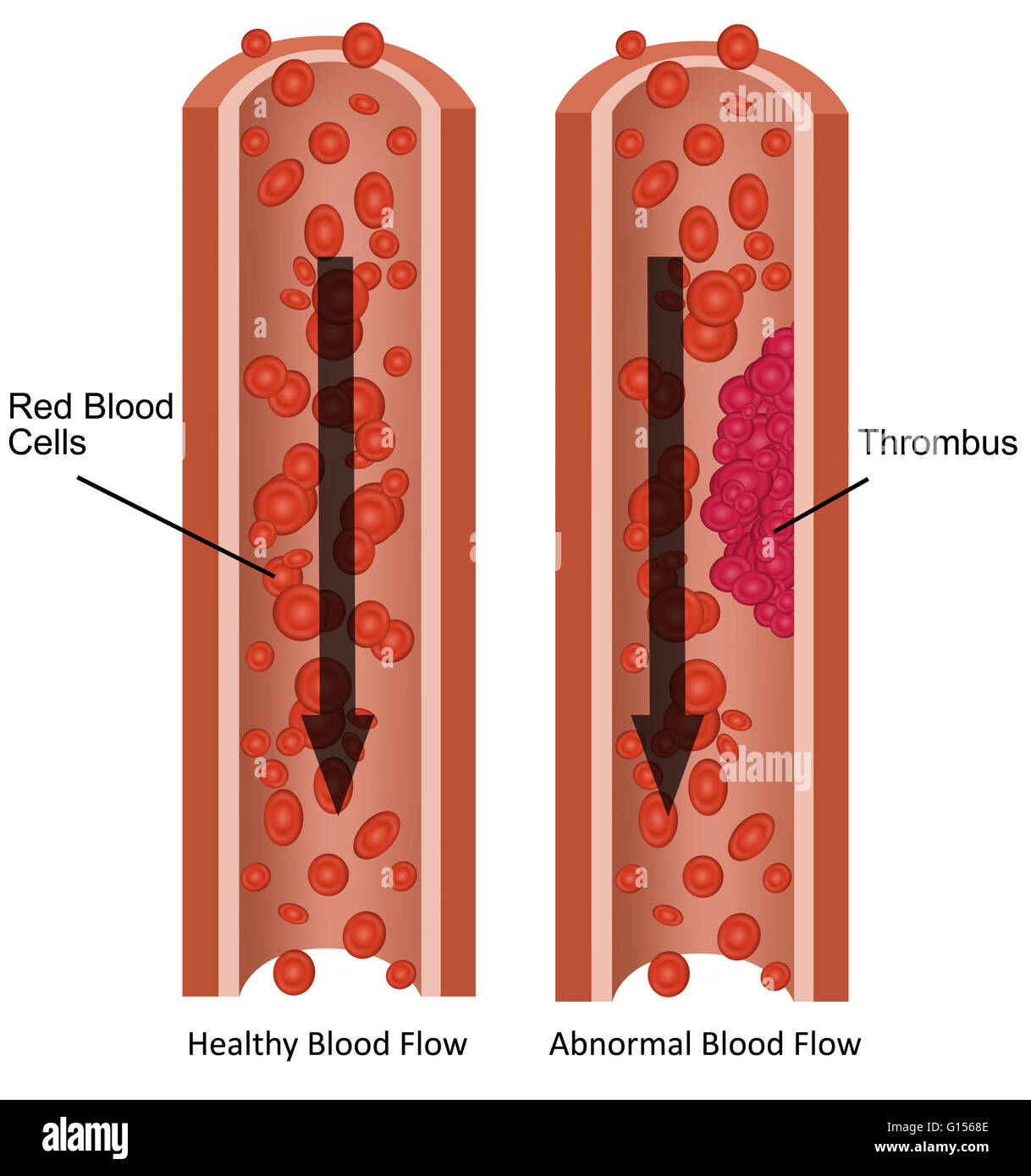 Le illustrazioni che mostrano una sana il flusso del sangue e anomali del flusso di sangue (coagulo di sangue o trombo). Foto Stock