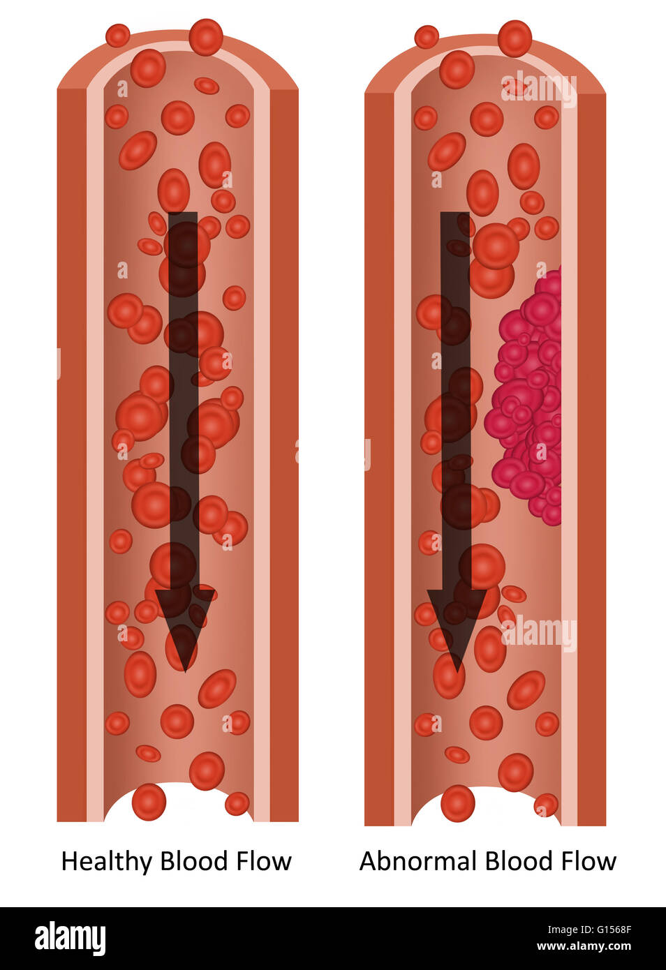 Le illustrazioni che mostrano una sana il flusso del sangue e anomali del flusso di sangue (coagulo di sangue o trombo). Foto Stock