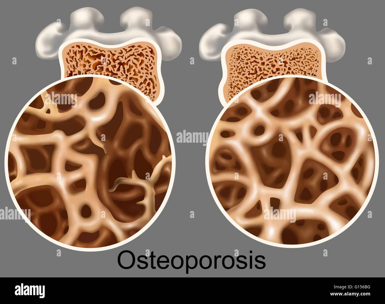 Immagine che mostra il confronto tra un normale e osso affette da osteoporosi. L'osso affette da osteoporosi a sinistra è un elemento poroso (morbido) osso mancante in massa e densità. L'osso compatto a destra mostra una normale massa e densità. Foto Stock