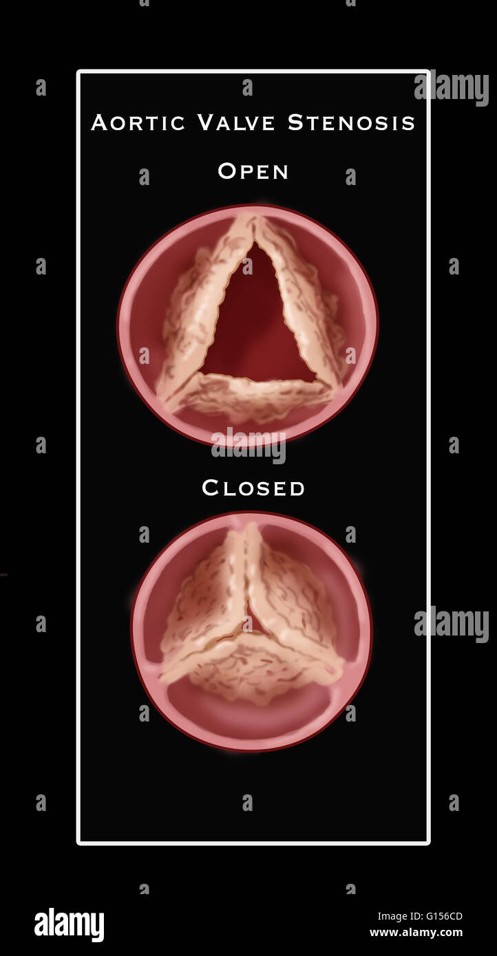 Illustrazione della valvola aortica stenosi, un tipo di malattia cardiaca valvolare caratterizzato da un restringimento anormale della valvola aortica apertura. Nella parte superiore è una chiusura di una valvola aperta, tuttavia, avviso non è completamente aperta e in fondo non è completamente c Foto Stock