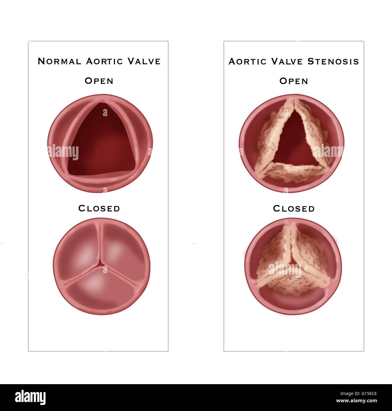 Immagine che mostra il confronto di una normale valvola aortica (sinistra) alla valvola aortica stenosi (a destra), un tipo di malattia cardiaca valvolare caratterizzato da un restringimento anormale della valvola aortica apertura. Foto Stock
