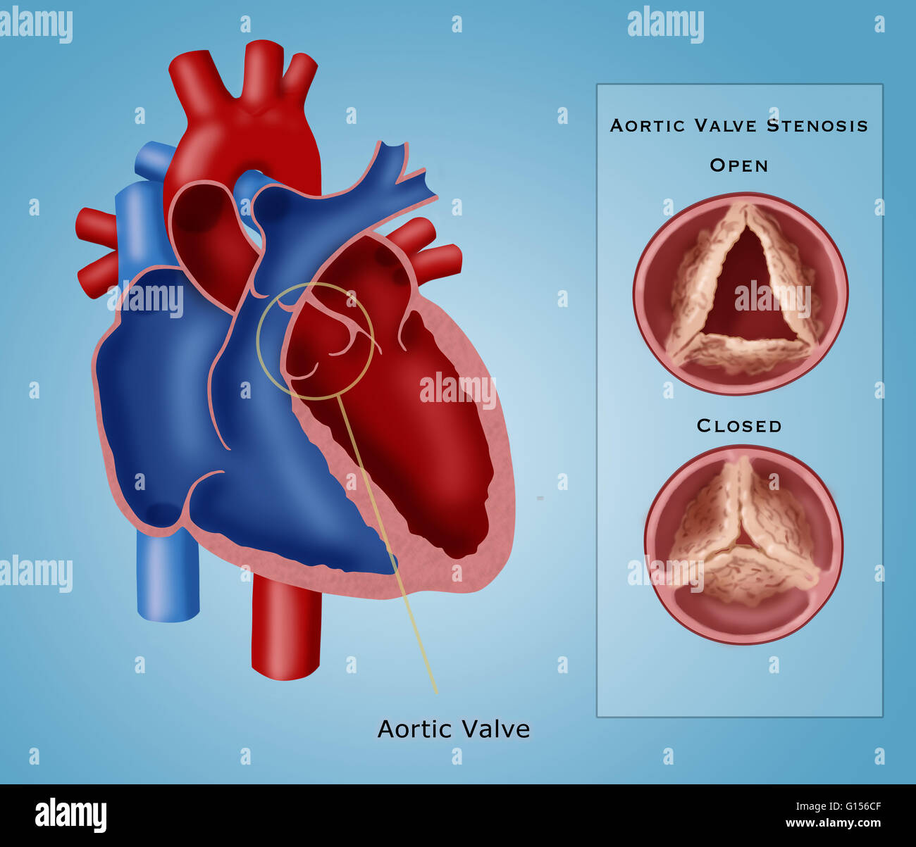 Illustrazione della valvola aortica stenosi, un tipo di malattia cardiaca valvolare caratterizzato da un restringimento anormale della valvola aortica apertura. A destra è una chiusura di una valvola aperta (in alto), tuttavia, la comunicazione non è completamente aperta, e ristretto o chiuso (a b Foto Stock