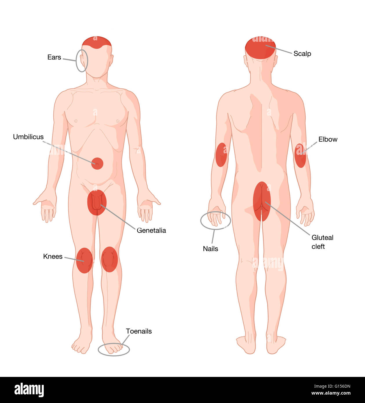 Diagramma che mostra le zone del corpo più comunemente colpite dalla psoriasi. Foto Stock