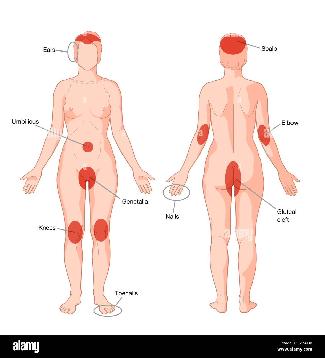 Diagramma che mostra le zone del corpo più comunemente colpite dalla psoriasi. Foto Stock