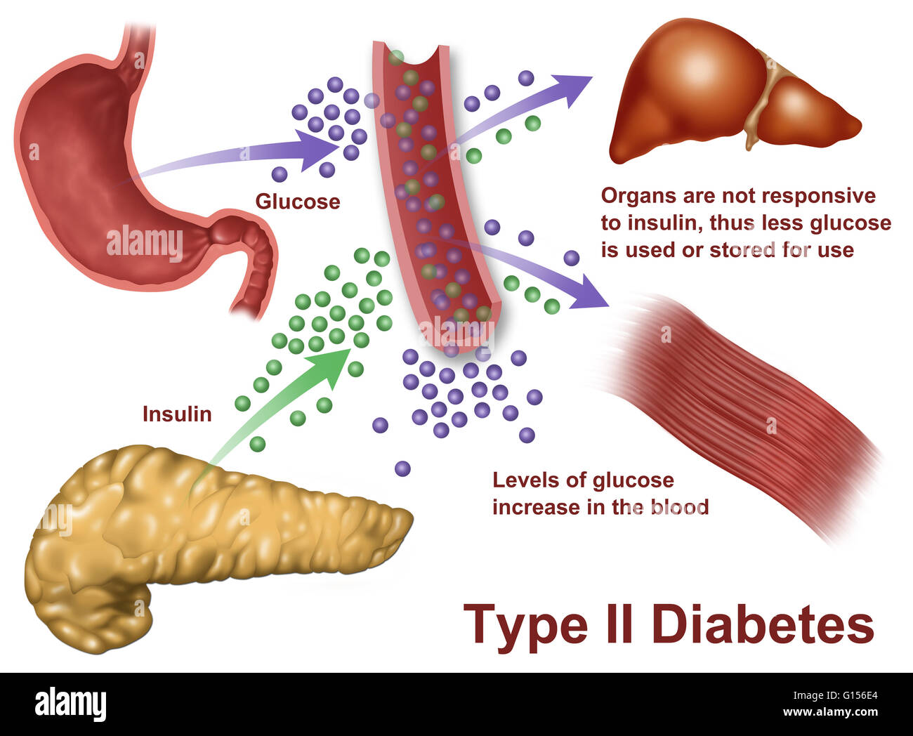 Llustration di insulina e la produzione di glucosio nel diabete di Tipo 2. L'insulina è prodotta da cellule insulari del pancreas, e agisce in sincronia con il glucosio per regolare l'energia in le cellule dell'organismo. Nel diabete di Tipo 2, come mostrato qui di seguito, il corpo si sviluppa alta sangue g Foto Stock