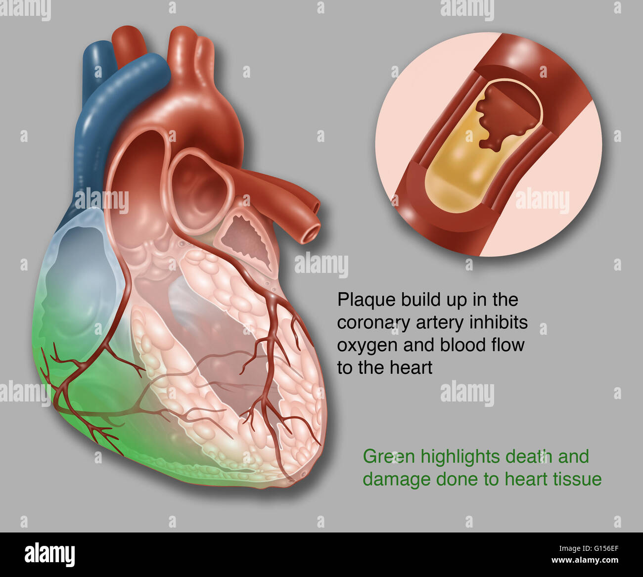 Llustration mostra insufficienza cardiaca acuta. Riducono l'accumulo di  placca in arteria coronaria inibisce l'ossigeno e il flusso di sangue al  cuore. Aree verdi evidenziare la morte e danni al tessuto del cuore