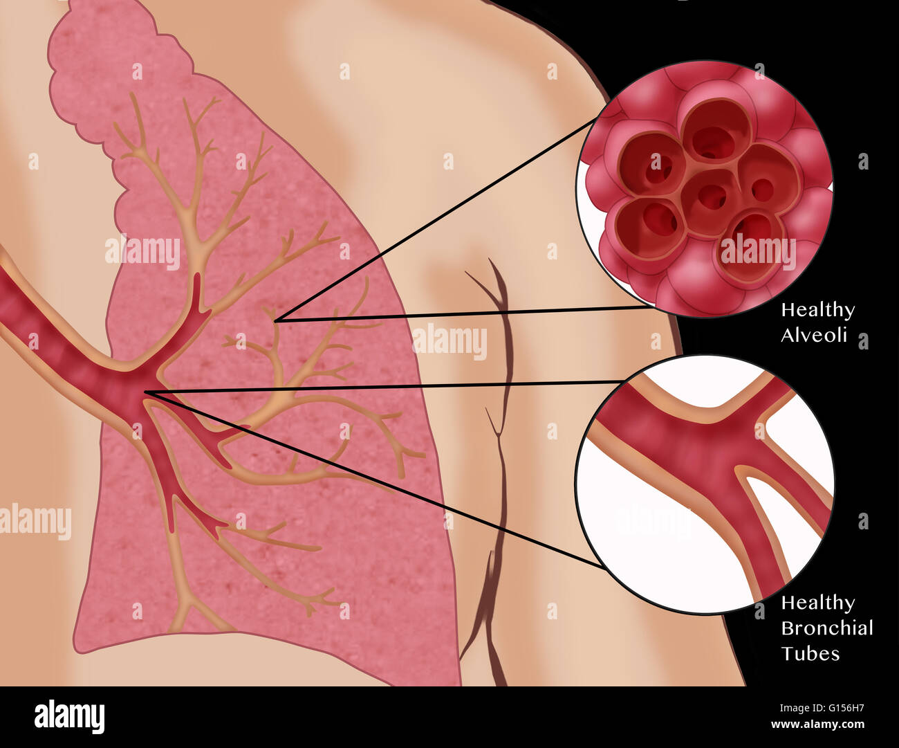 Illustrazione di un polmone sano, con close-up opinioni dei bronchi e alveoli. Foto Stock