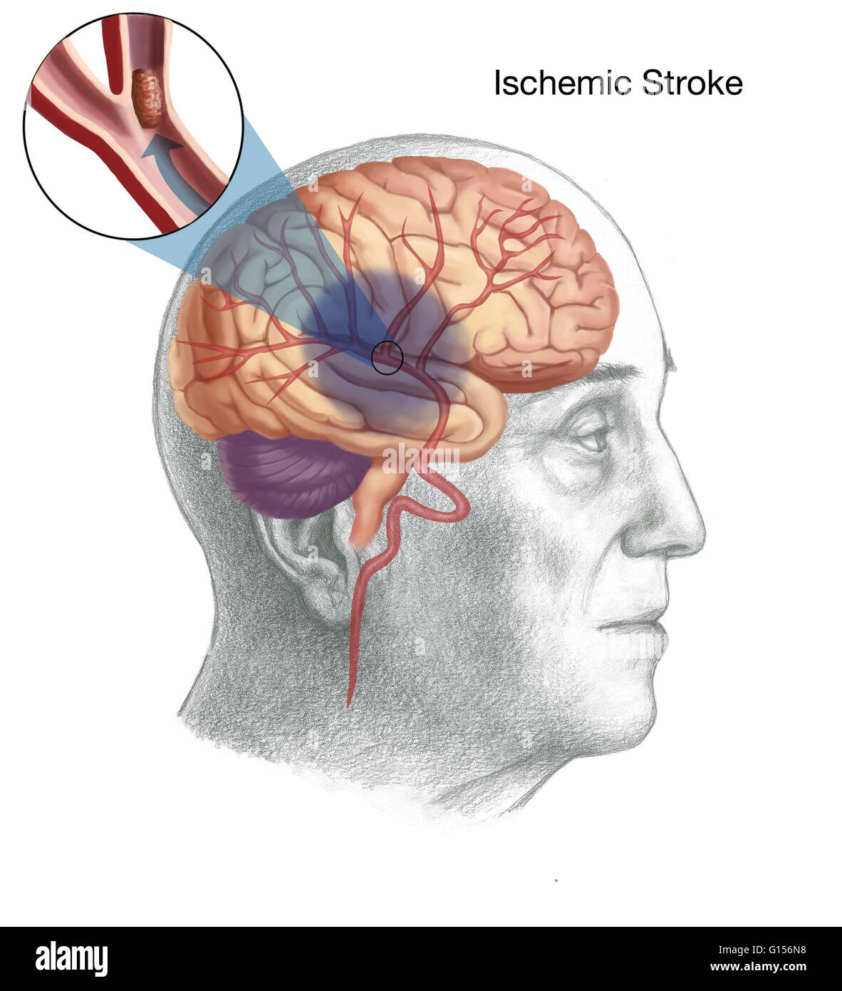 Illustrazione che mostra il meccanismo di una corsa ishemic. In un ictus ischemico, alimentazione di sangue da parte del cervello è diminuito, che portano a una disfunzione di quella zona del cervello. Qui, un coagulo di sangue è il motivo per cui si è limitato il flusso di sangue. Foto Stock