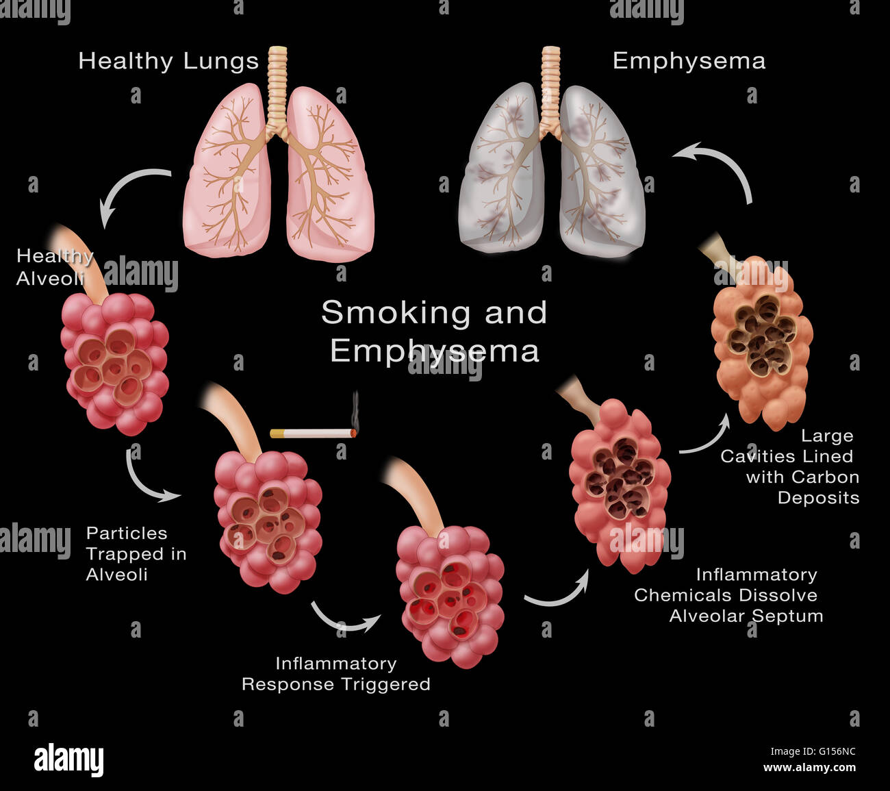 Fasi di danni ai polmoni di un fumatore che conduce all'enfisema.  L'illustrazione di cicli dalla parte superiore sinistra polmone sano verso  il basso e intorno alla parte superiore del polmone destro che