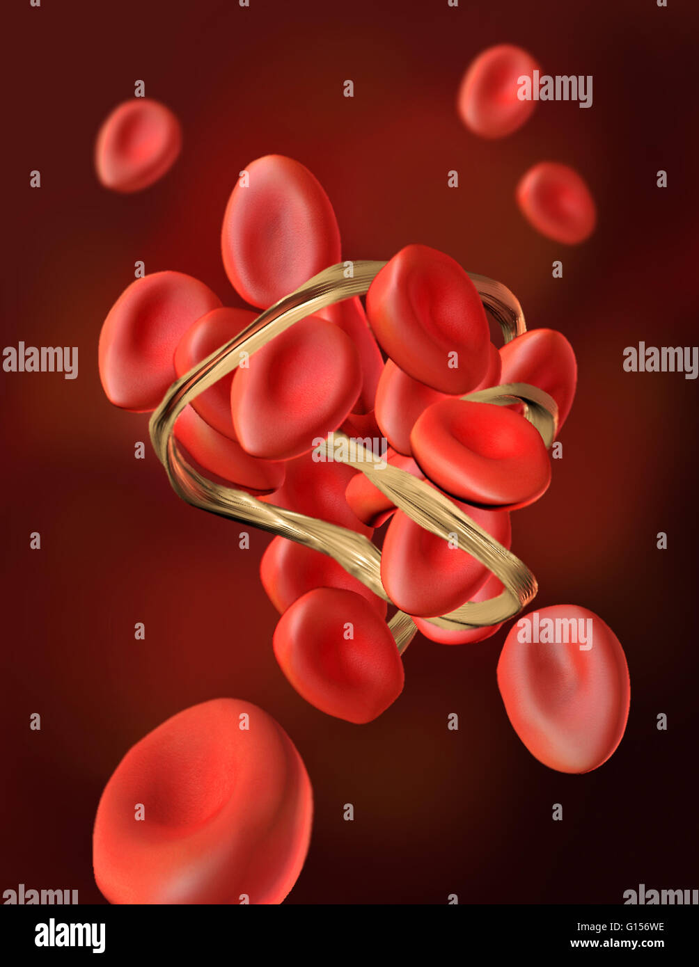 Illustrazione della trombosi. La trombosi si verifica quando una formazione di coaguli sanguigni ostruisce il flusso del sistema circolatorio. Foto Stock